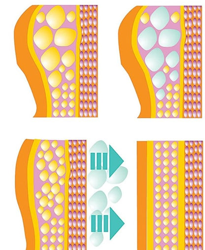 Dispositivo de congelacion de grasa abdominal