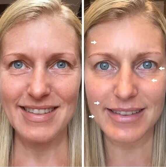 Rejuvenecedor Facial Ultrasonico